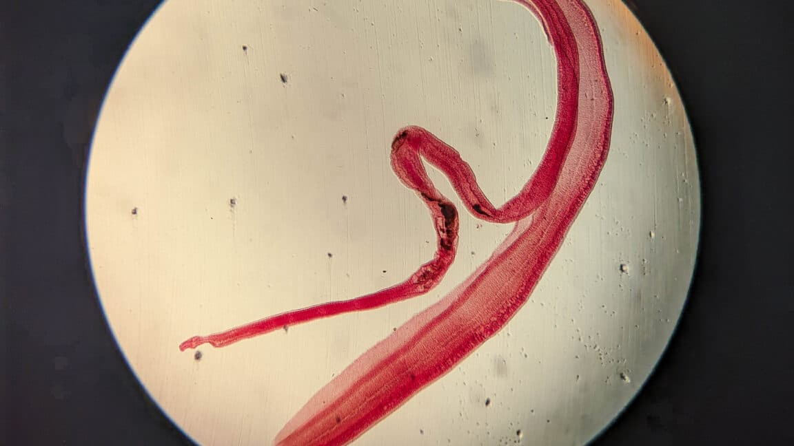 Unusual Brain Parasite Infection Diagnosed via Lab Test